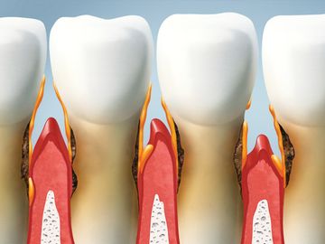 Gum Disease | Periodontitis | Gingivitis |West Hartford | New Britain | Best Dentist | Whitening