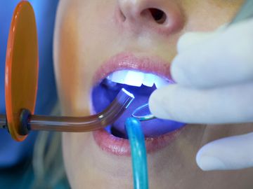 Bonding | Cosmetic Dentist | West Hartford | New Britain | Best | Dentist | Whitening