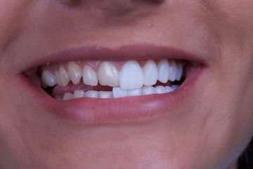 Porcelain Veneers | Lumineers | DaVinci | West Hartford CT Dentist | New Britain | Cosmetic Dentist