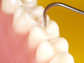 Tooth Colored | Fillings | Composite |  West Hartford | New Britain | Best | Dentist | Whitening