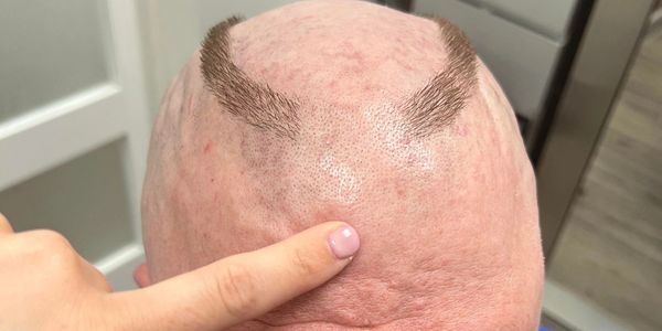 Pathetic sissy whore's top of a head with a very tiny circle strip of hair. Laugh at this bitch