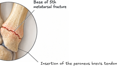 Illustration of a 5th metatarsal bone fracture.