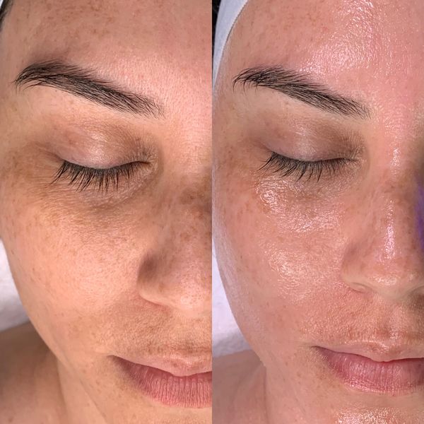 Hydrafacial client before and after photos of treatment. 
