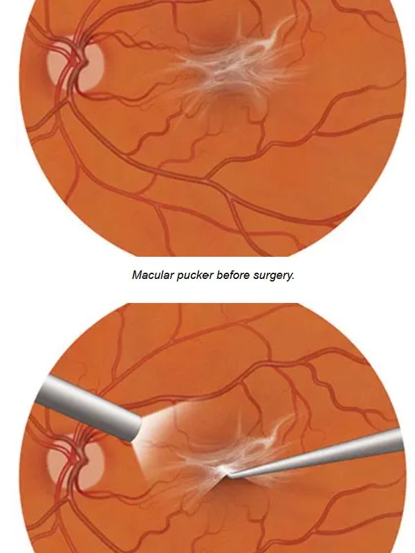 Epiretinal Membrane Removal surgery by Dr Jignesh Gala 