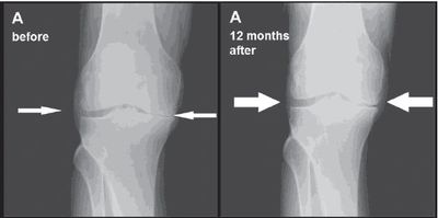 Stem cell therapy gets arthritis patients back in the game - Vero News