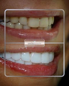 Laser Teeth Whitening