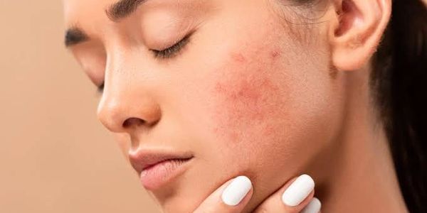 Best Acne Scar Treatment in Bengaluru at Dr. Singh's Cosmedica Department in Halasuru Skin Clinic