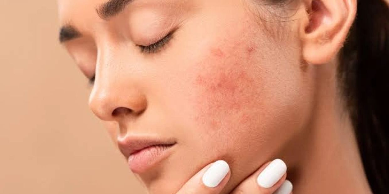 Woman with acne on her cheek.