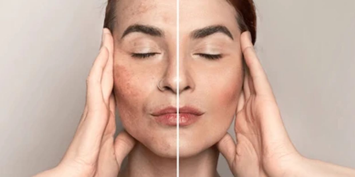Clinical Pigmentation & Melasma treatment results at Dr. Singh's Cosmedica, Halasuru, Bengaluru.
