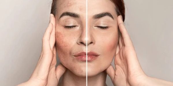Best Pigmentation treatment in Bengaluru at Dr. Singh's Cosmedica Department in Halasuru Skin Clinic