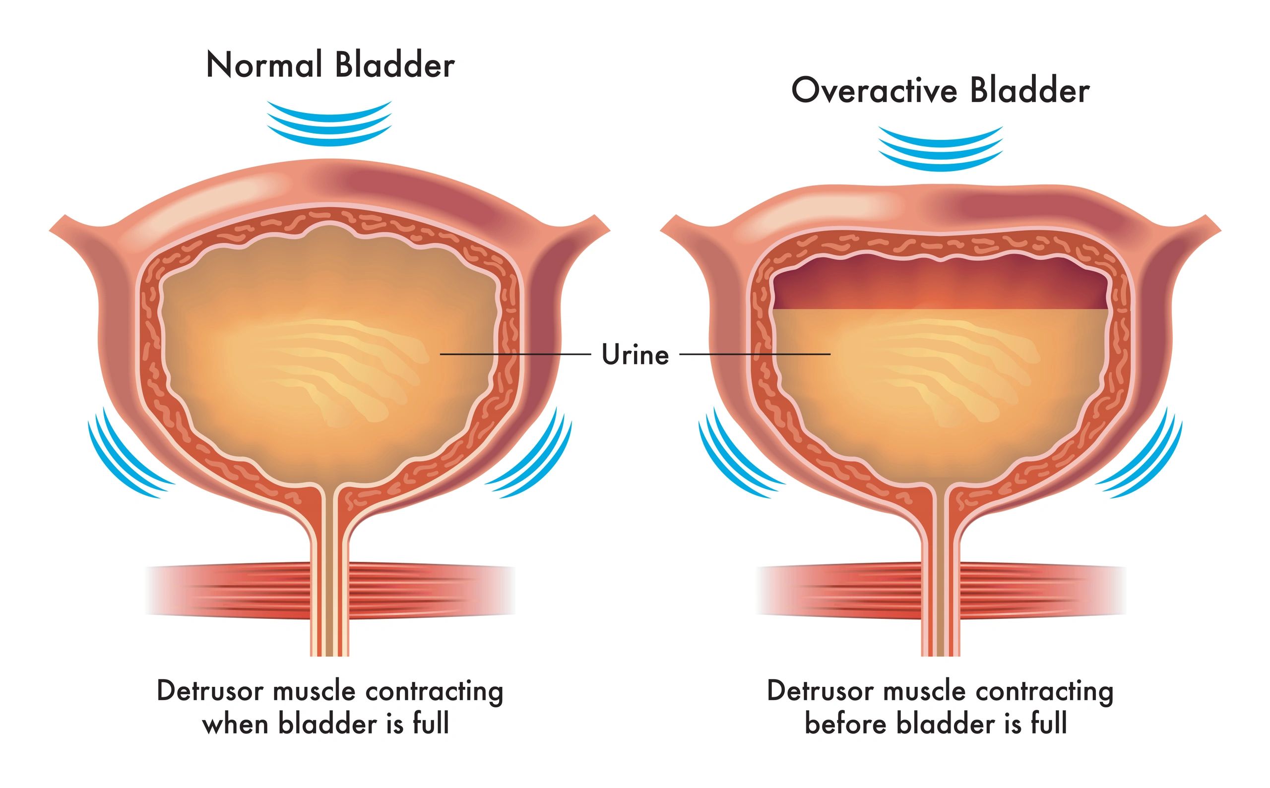 bladder-botox-to-treat-incontinence-bbc-news