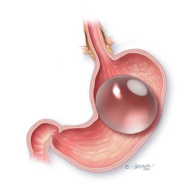 Gastric Balloon in Brisbane