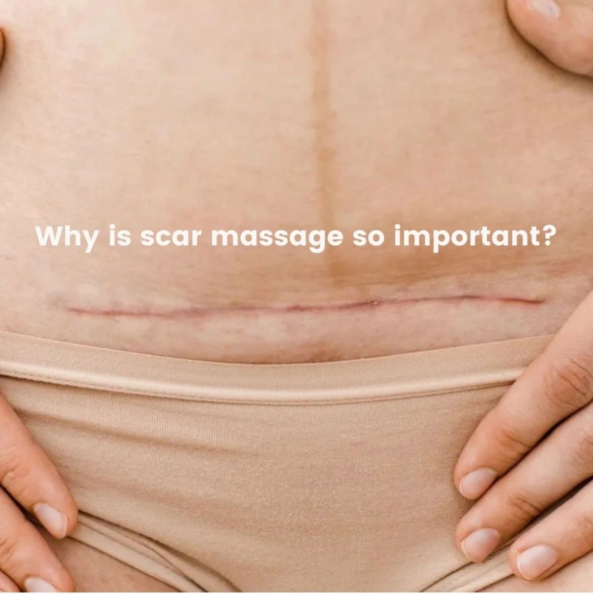 What to Know About Cesarean Scars