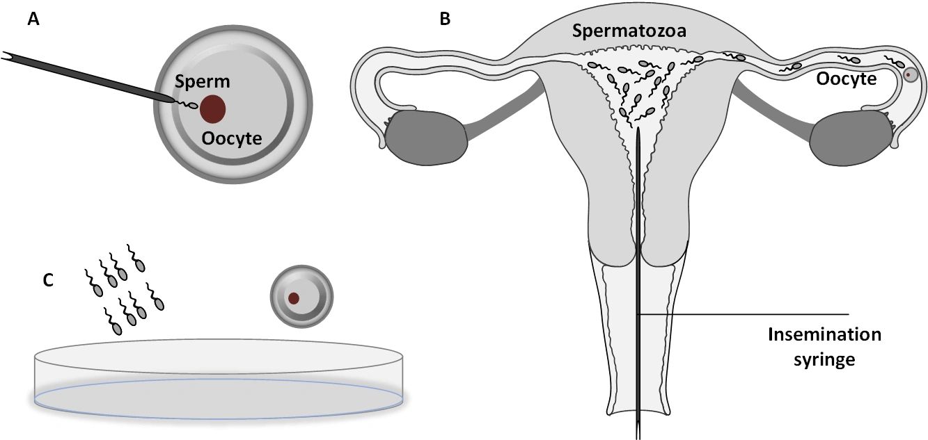 Artificial Reproductive Techniques (ARTs)