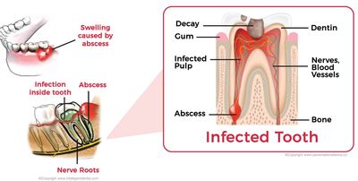 Untreated toothache can lead to life threatening abscess and severe pain due to the infected tooth.
