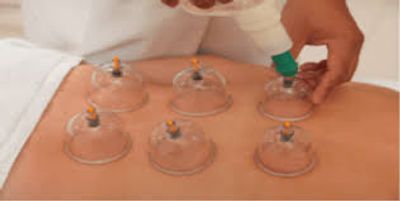 Cupping performed on person laying down 