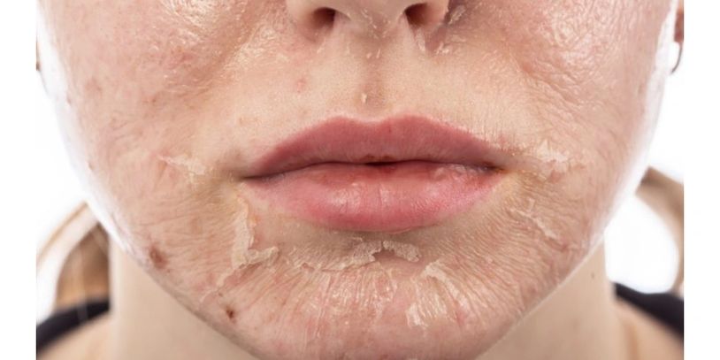 Skin treatment for skin renewal, hyperpigmentation, acne, fine lines, wrinkles