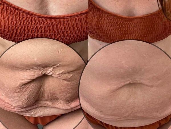 Firmer skin
