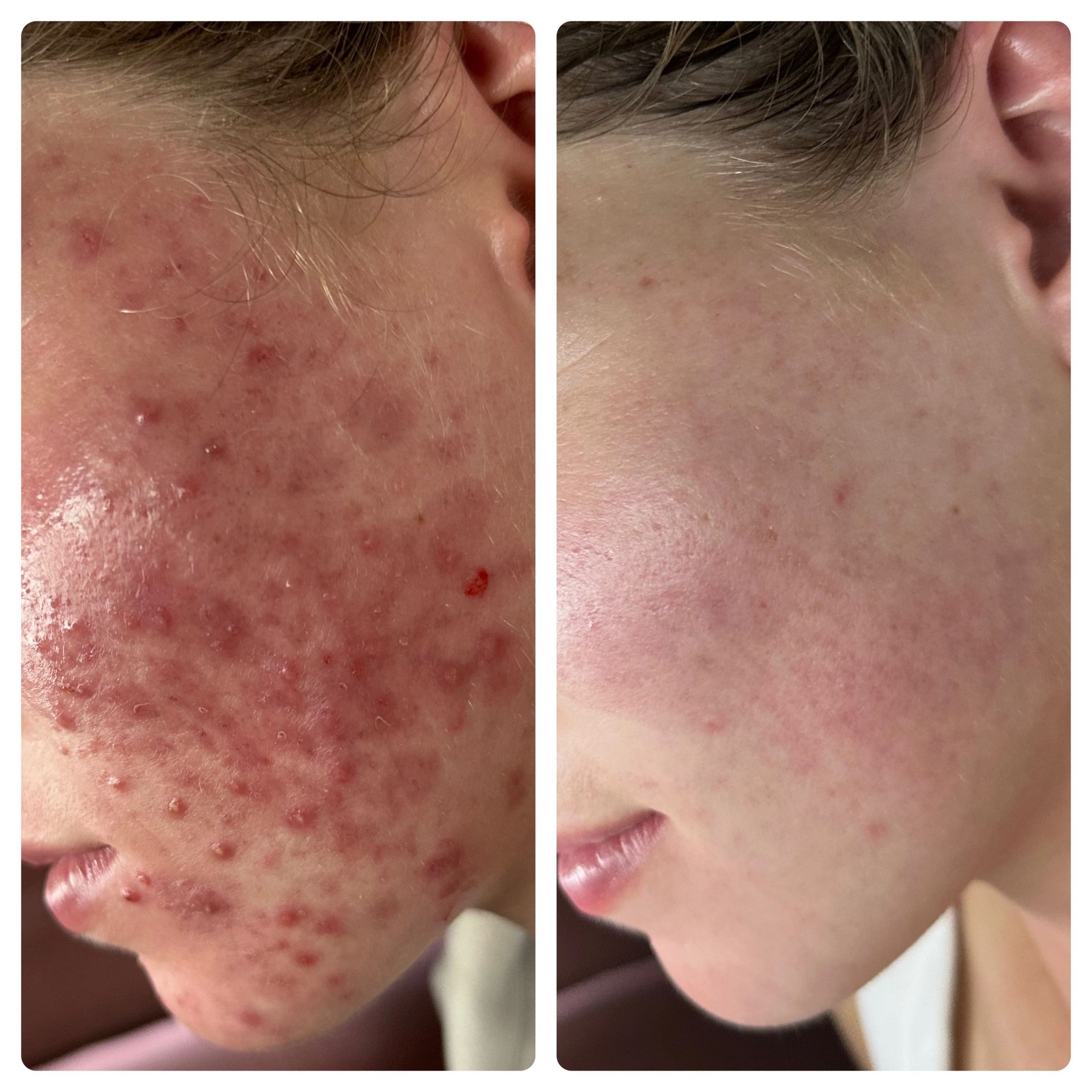 lient Results | Serenity Acne & Aesthetics Windsor CO