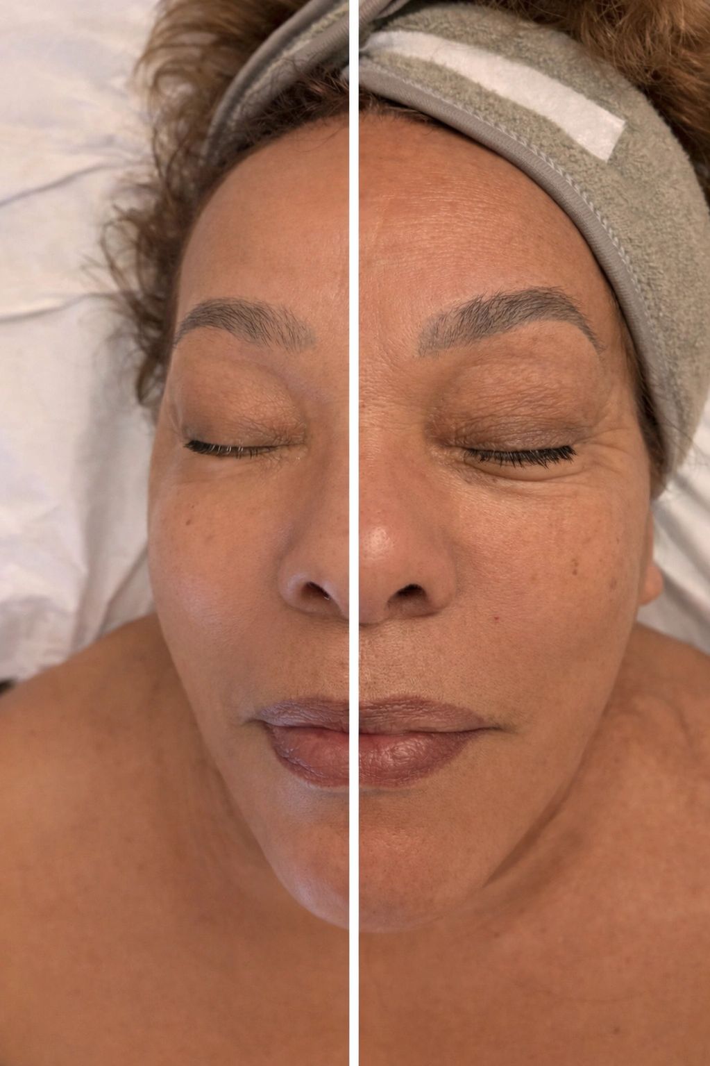 Before & After TMJ & Natural Lift Face Massage 