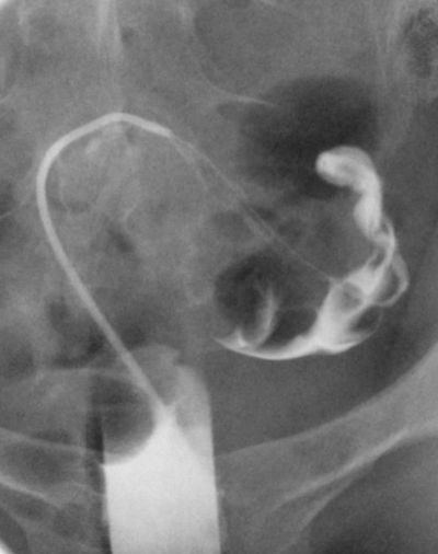 Fallopian tube recanalization