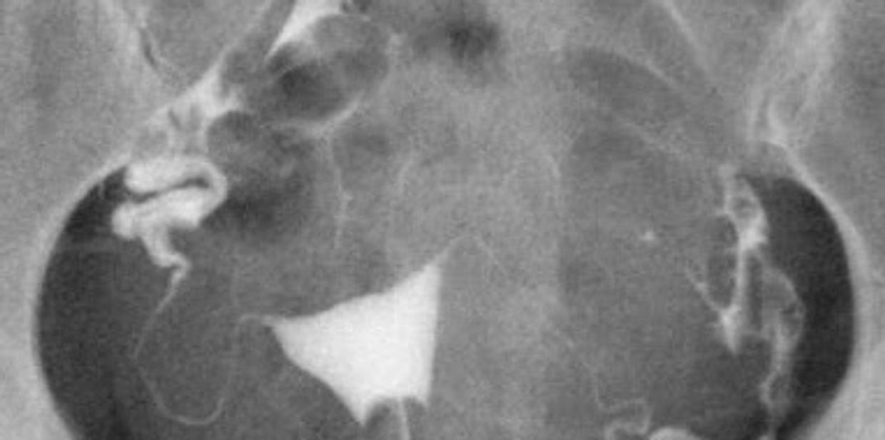 Normal Hysterosalpingogram