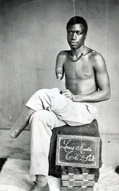Portrait of a man with amputated limbs sitting on a crate.