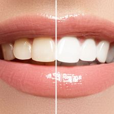 teeth whitening dentist silver spring