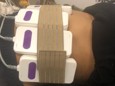 Laser Lipo to sculpt the waistline following a Wood Therapy treatment. 