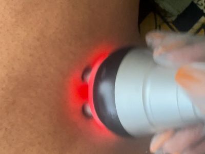 Radio Frequency- The ideal finisher following a body sculpting treatment.