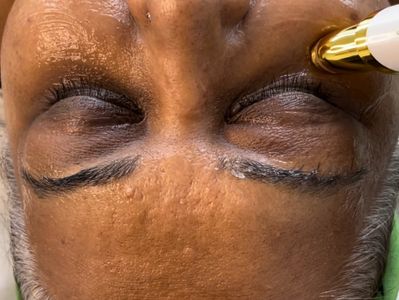 Targeting the under eye area with micro current .