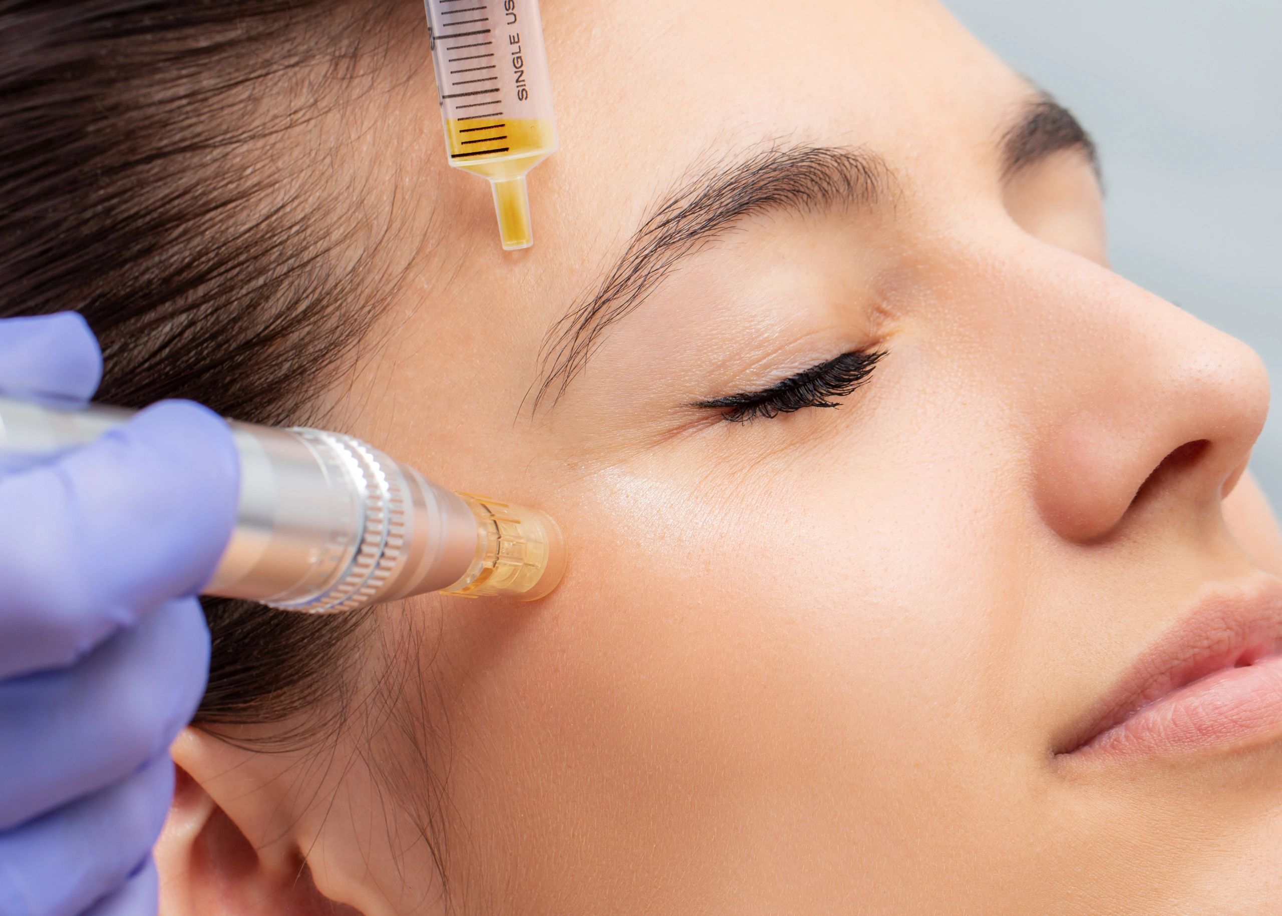 Micro-needling treatments for fine lines, sagging, hyperpigmentation, acne, scars, and more.