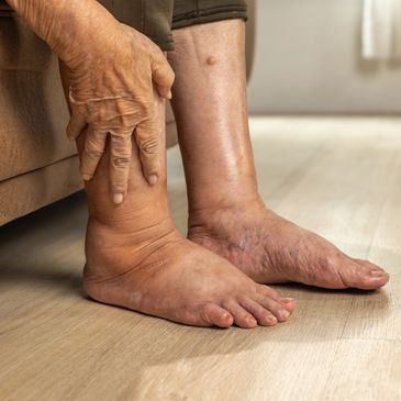 Diabetic foot anxieties or changes