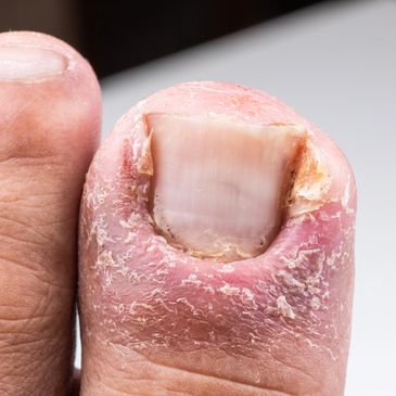 Thick, discolored, or ingrown toenails