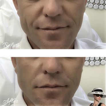 Cheeks and Smile Lines