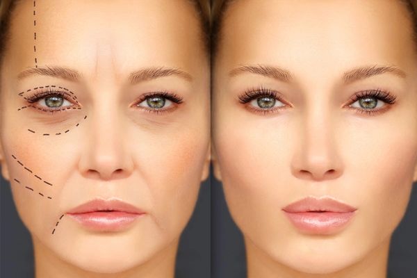 Side-by-side comparison of a woman's face before and after cosmetic enhancement.