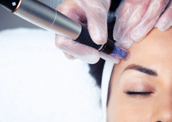 Microneedling treatment being performed on a woman's forehead.