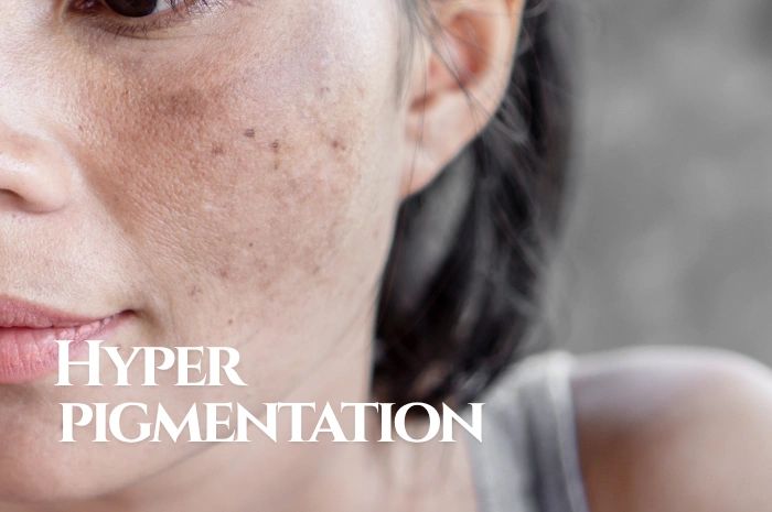 Close-up of hyperpigmentation on a woman's cheek coming to Linora Aesthetics