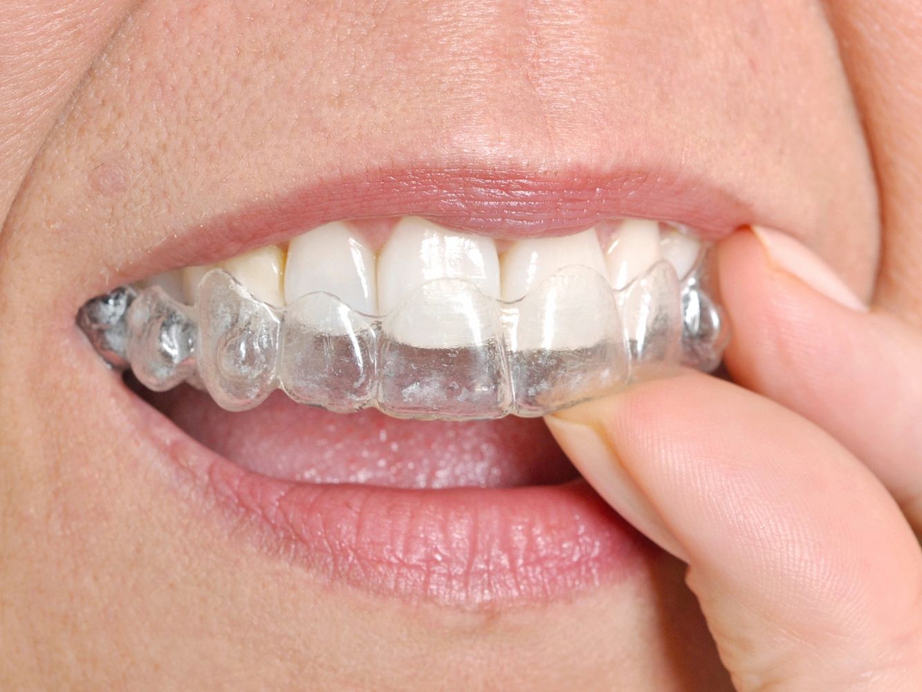 Your life is moving. Your smile should keep up. Get treated with Invisible aligners today.