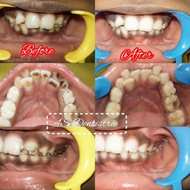 Shine bright! Pediatric scaling remove extrinsic stains promoting a healthy and confident smile 

