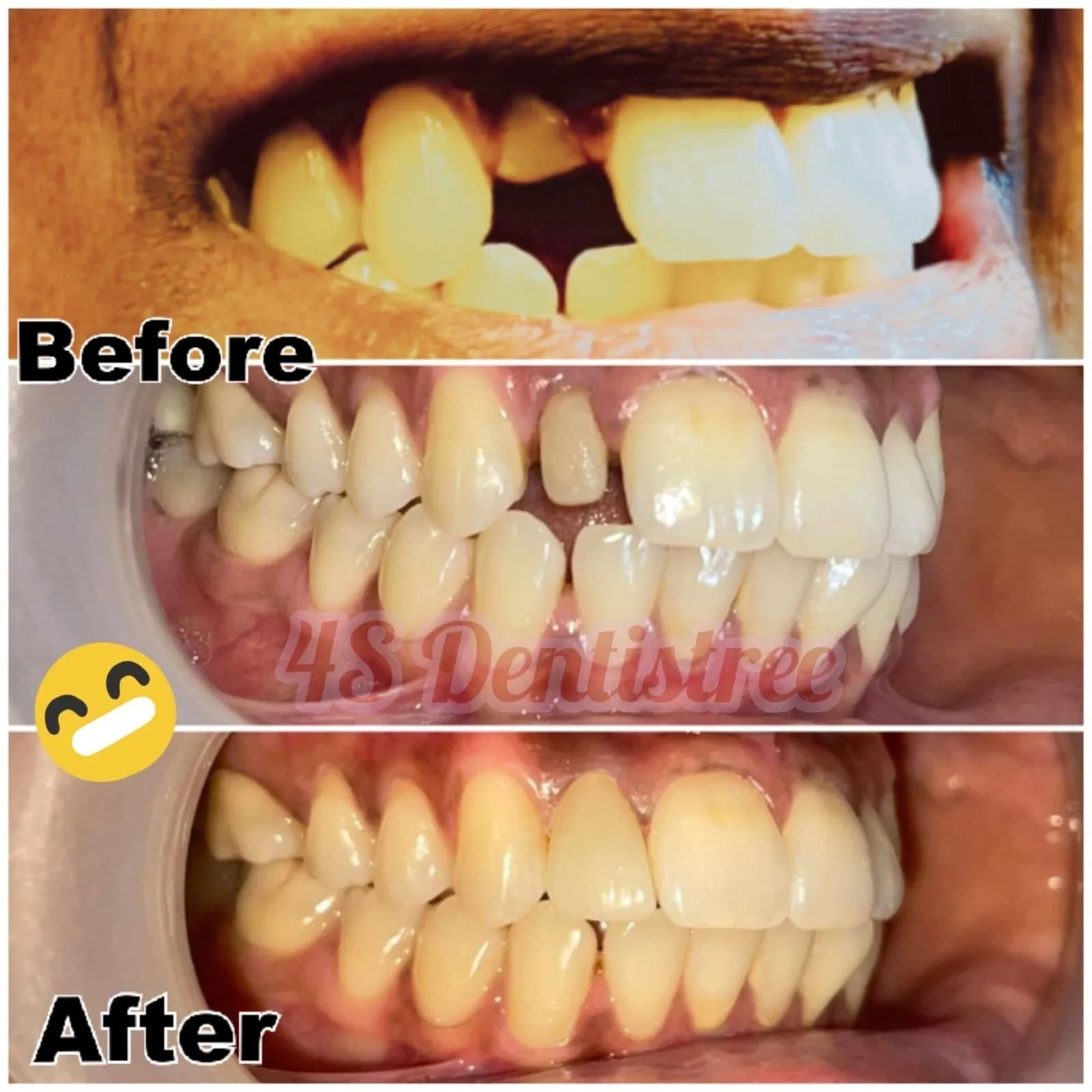 Metal post followed by zirconia crown to bring back her smile.
#4sdentistree #yoursmileourpassion 