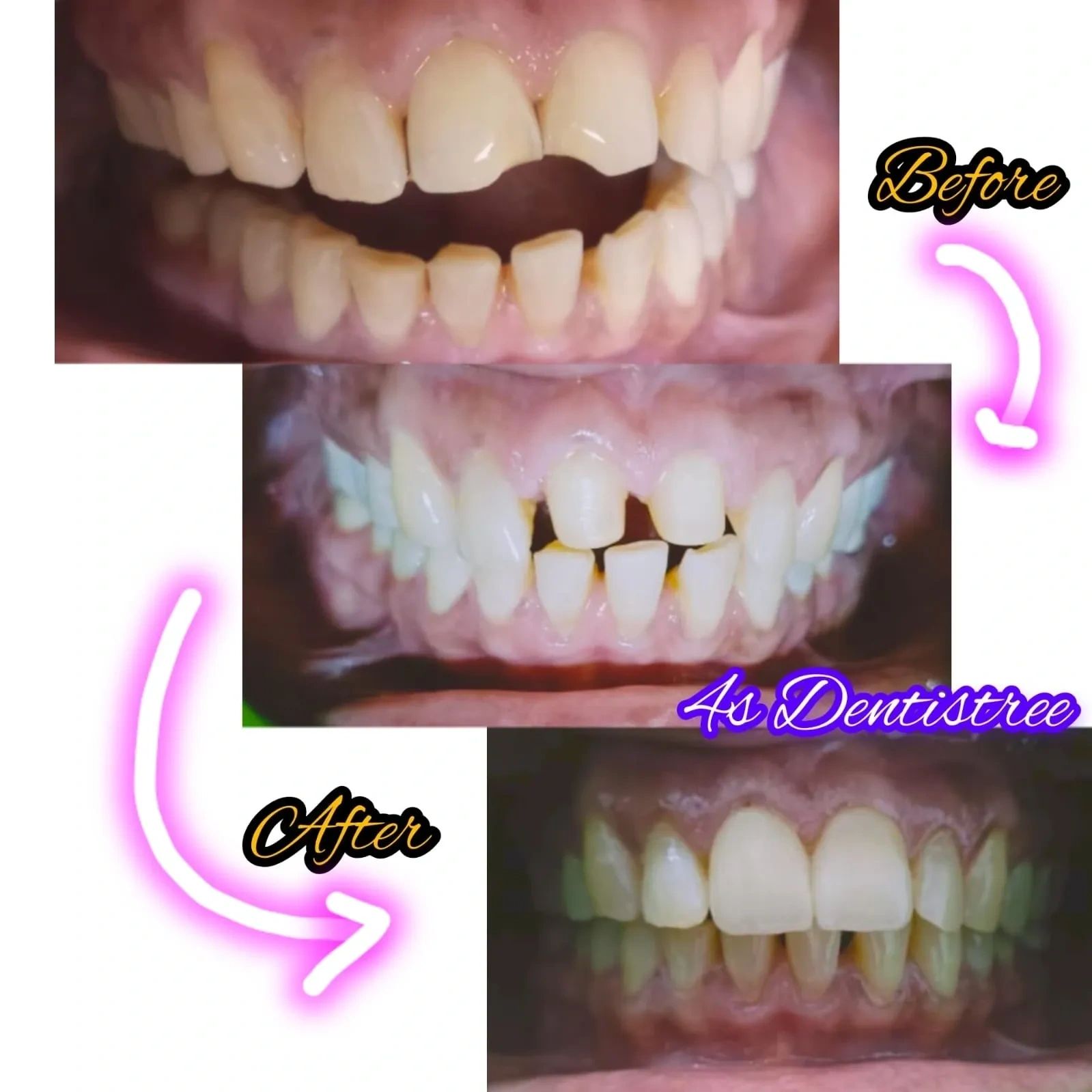 Anterior zirconia crowns