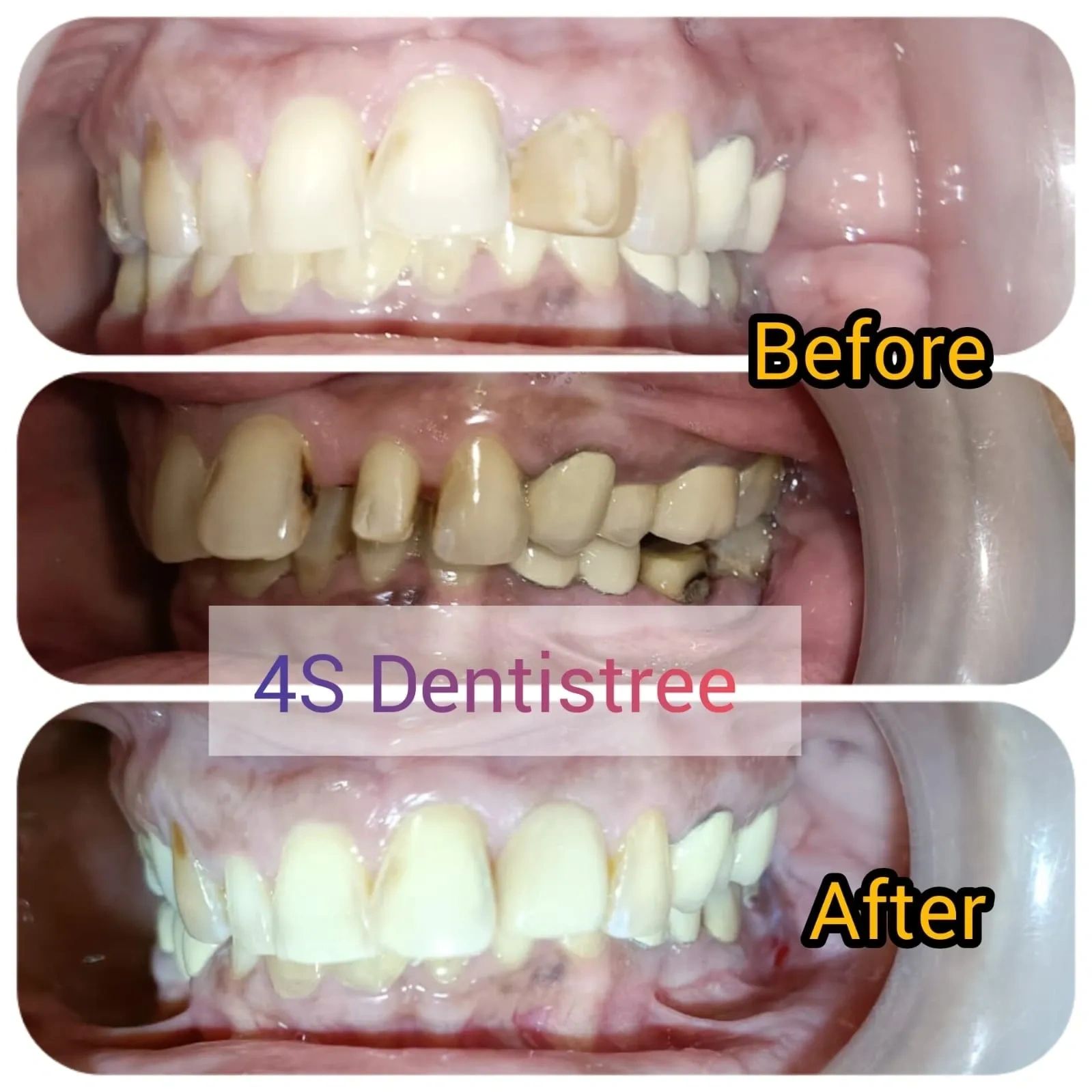 Anterior crowns are dental restoration that cover the front teeth for aesthetics, normal function
