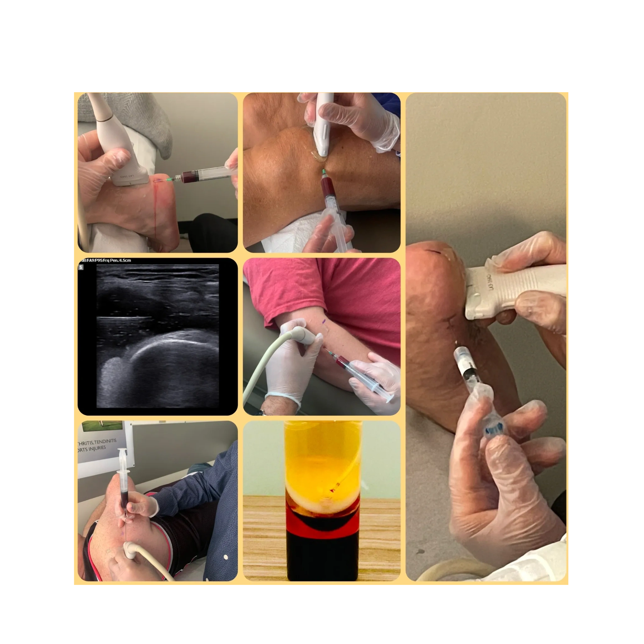 bpc 157 bacteriostatic Peptide Therapy for Injury Repair: Faster Healing with Regenerative  Orthopedic Support main image 1