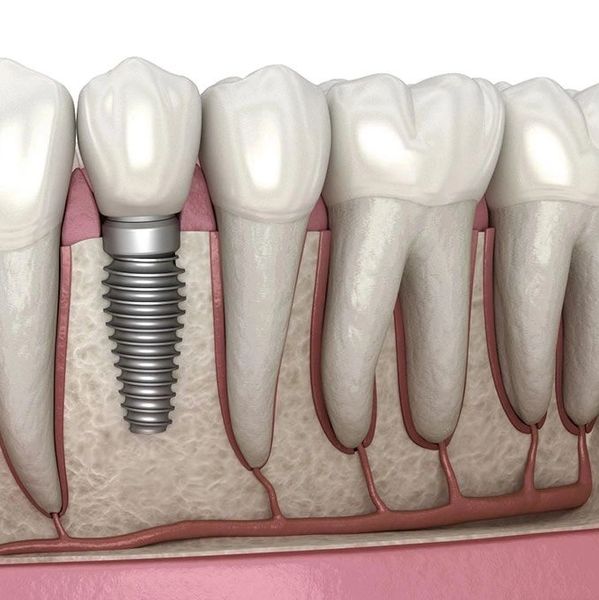 Dental Implants at Global Smiles Dental in Indianapolis, Indiana 46237