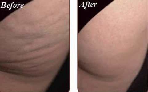 Lipo Dissolve Mesotherapy | Canadian College of Aesthetic Dermatology