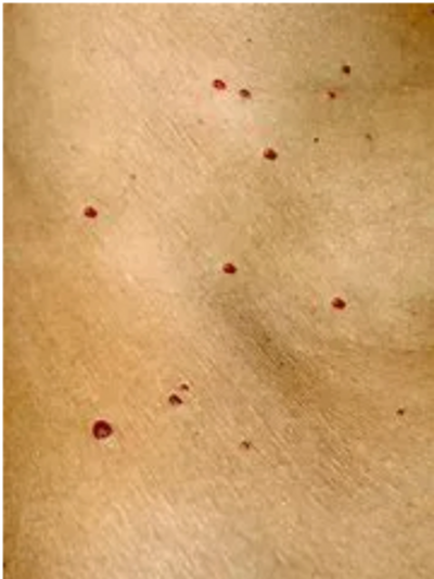 red round spots cherry angioma chest arm face laser removal Stockport clinic