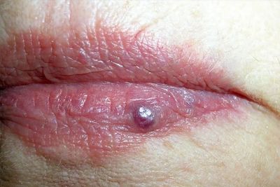dark red spot on lip venous lake quick laser removal safe Yag laser Stockport clinic