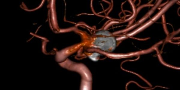 3D angiogram of a coiled posterior communicating region aneurysm