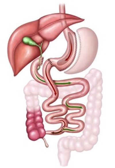 Obezite, Obezite Cerrahisi, Metabolik Cerrahi, Şeker Hastalığı, Tüp Mide,Mide Botoksu